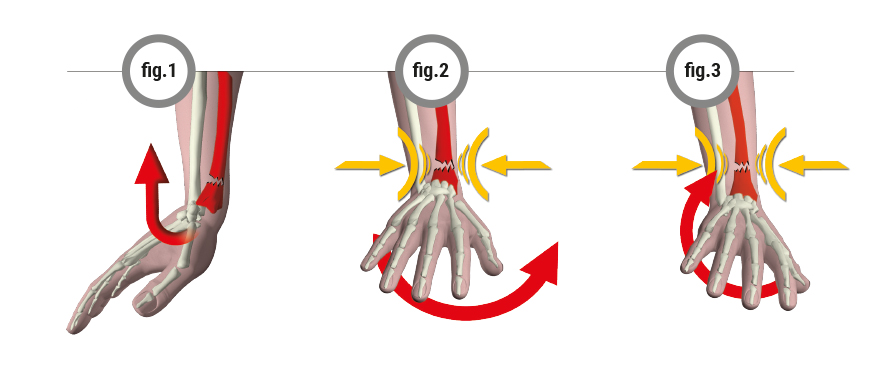 Fracture fig.1